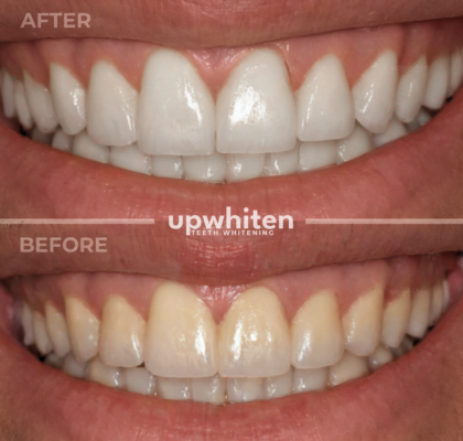 Teeth whitening before and after comparison in Ottawa (4)