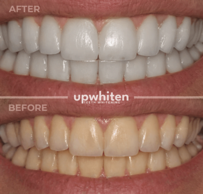 Teeth whitening before and after comparison in Ottawa (3)